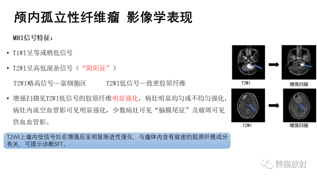 影像PPT - 【病例】颅内孤立性纤维性肿瘤2例CT及MR影像-21