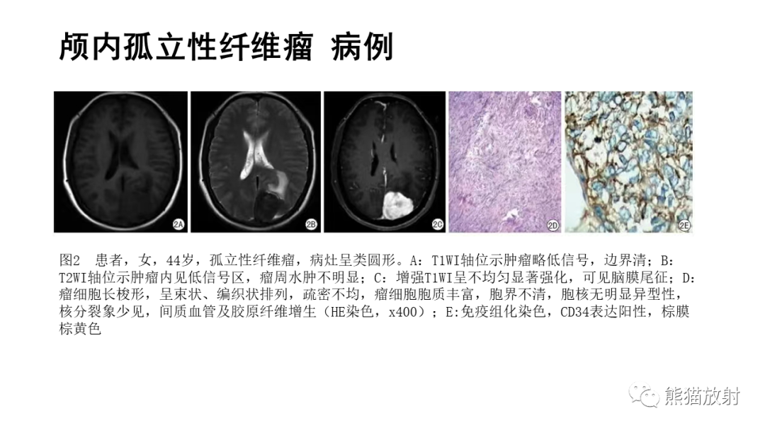 影像PPT - 【病例】颅内孤立性纤维性肿瘤2例CT及MR影像-24
