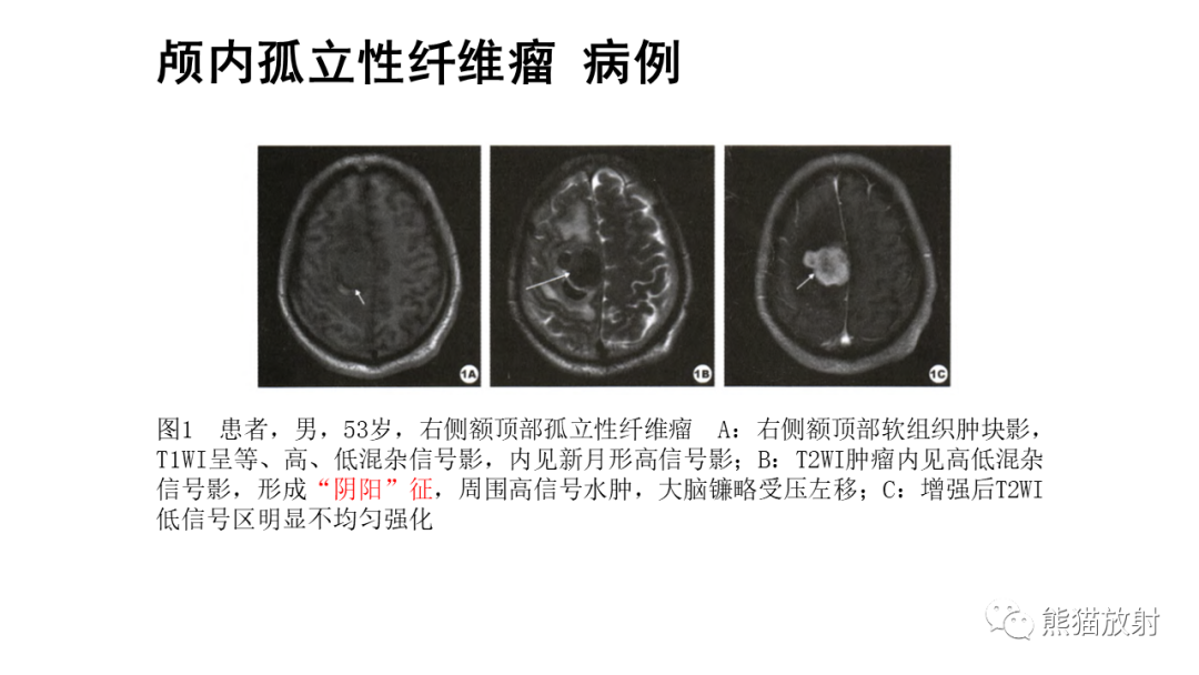 影像PPT - 【病例】颅内孤立性纤维性肿瘤2例CT及MR影像-23