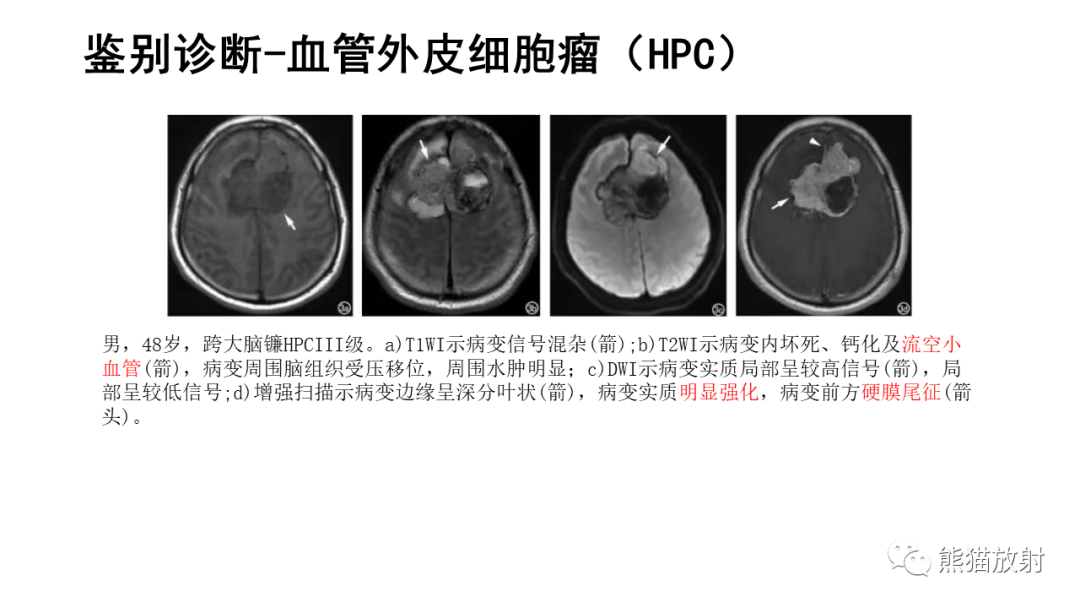 影像PPT - 【病例】颅内孤立性纤维性肿瘤2例CT及MR影像-27
