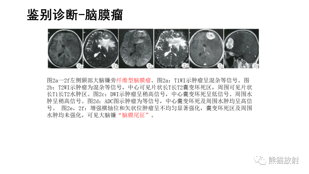 影像PPT - 【病例】颅内孤立性纤维性肿瘤2例CT及MR影像-30