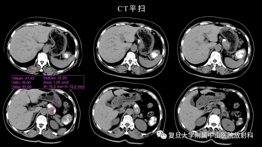 影像PPT - 【病例】胃肠道神经内分泌肿瘤1例CT及MR-3