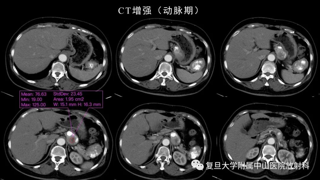 影像PPT - 【病例】胃肠道神经内分泌肿瘤1例CT及MR-4