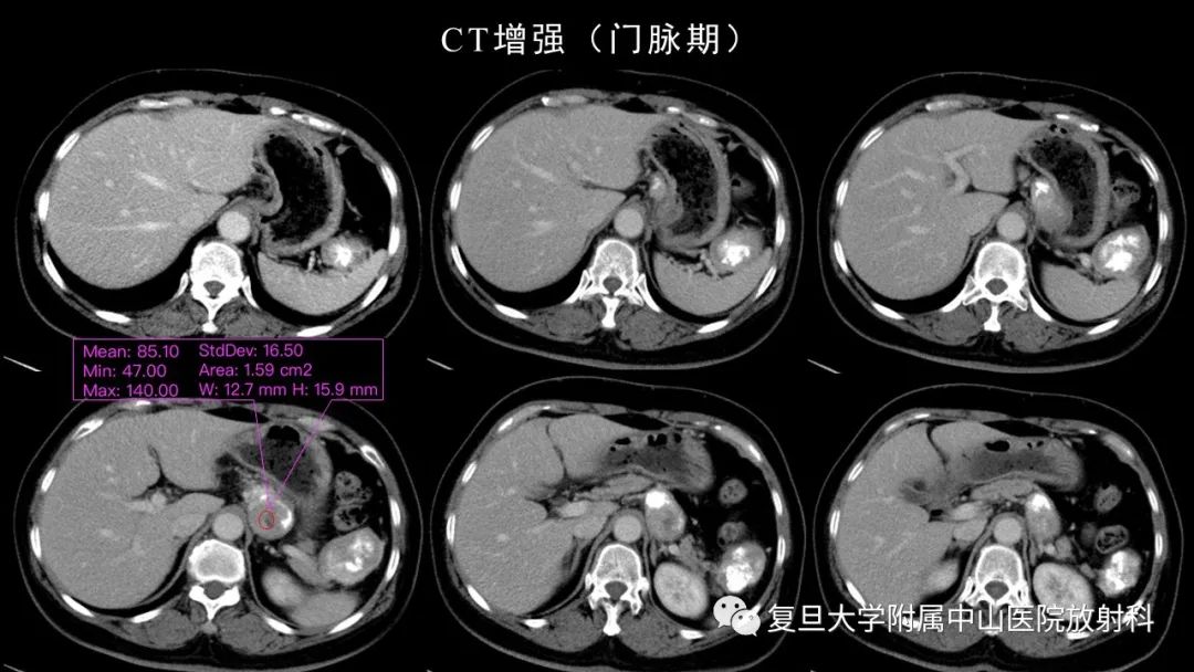 影像PPT - 【病例】胃肠道神经内分泌肿瘤1例CT及MR-5