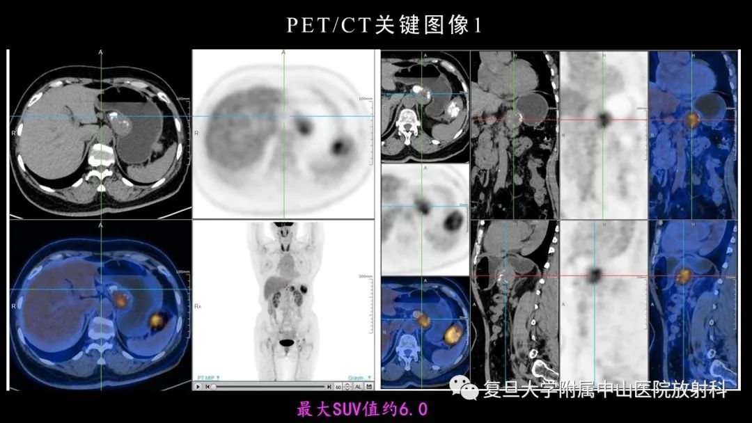 影像PPT - 【病例】胃肠道神经内分泌肿瘤1例CT及MR-6