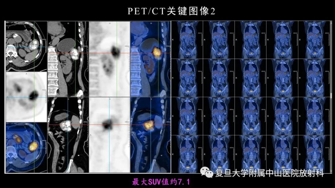 影像PPT - 【病例】胃肠道神经内分泌肿瘤1例CT及MR-7