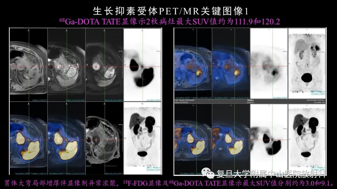 影像PPT - 【病例】胃肠道神经内分泌肿瘤1例CT及MR-8