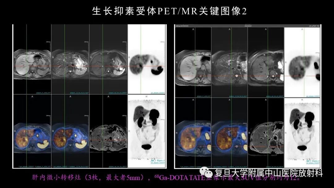 影像PPT - 【病例】胃肠道神经内分泌肿瘤1例CT及MR-9