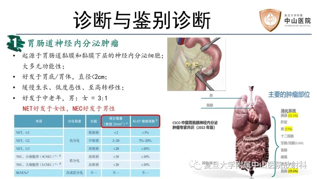 影像PPT - 【病例】胃肠道神经内分泌肿瘤1例CT及MR-13