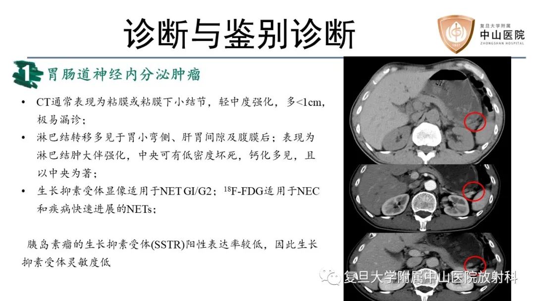 影像PPT - 【病例】胃肠道神经内分泌肿瘤1例CT及MR-14