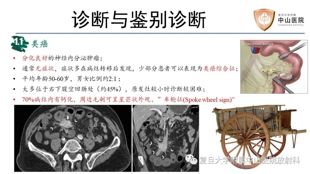 影像PPT - 【病例】胃肠道神经内分泌肿瘤1例CT及MR-15