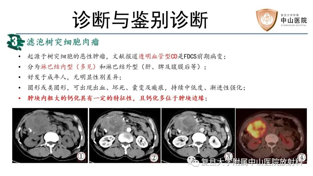 影像PPT - 【病例】胃肠道神经内分泌肿瘤1例CT及MR-17
