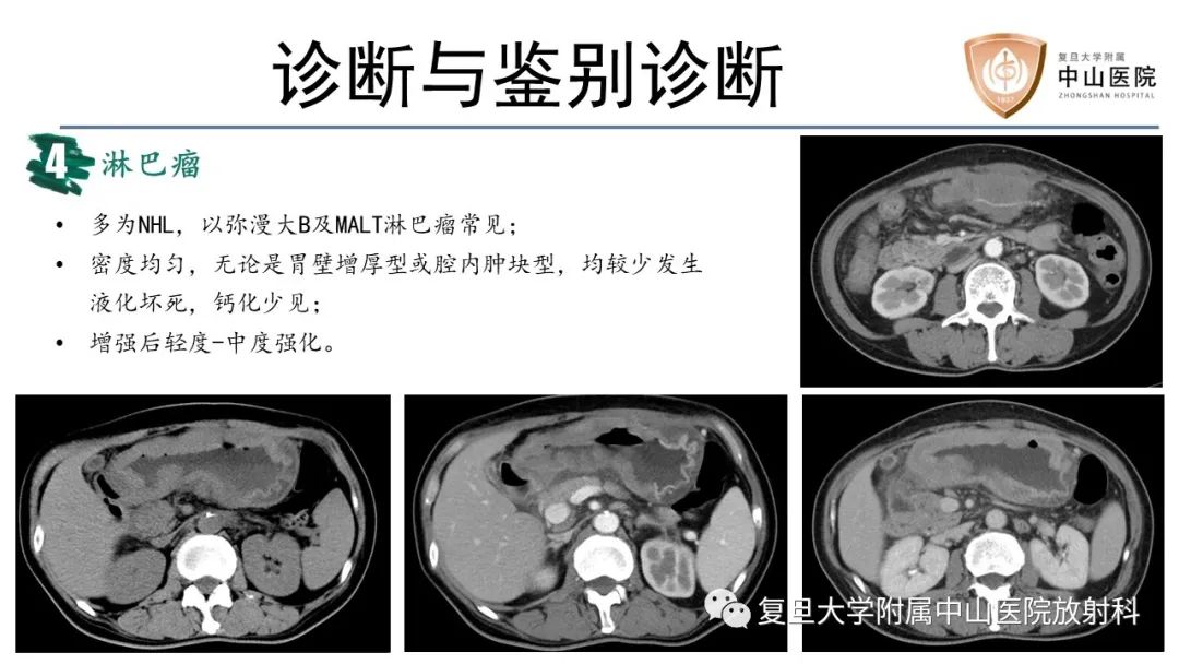 影像PPT - 【病例】胃肠道神经内分泌肿瘤1例CT及MR-18