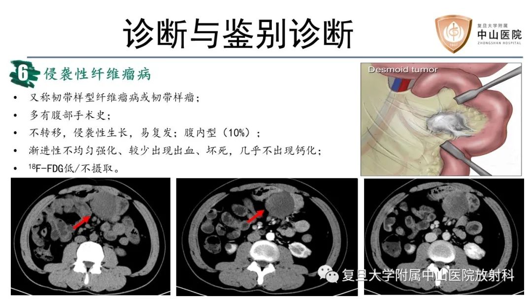 影像PPT - 【病例】胃肠道神经内分泌肿瘤1例CT及MR-20