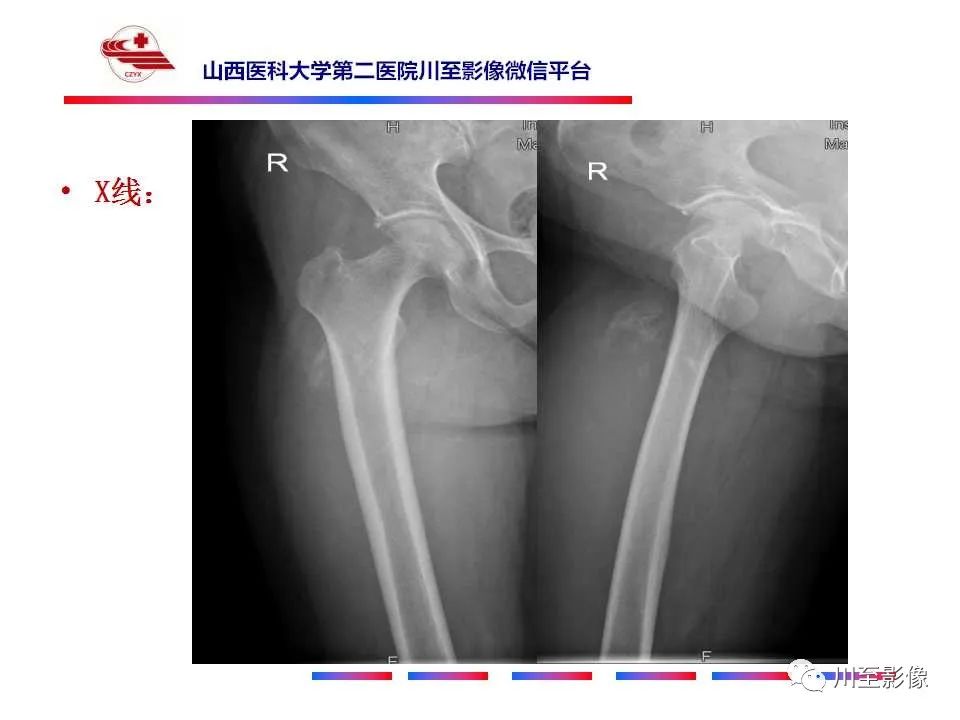 影像PPT - 【病例】大腿高级别表面骨肉瘤-4