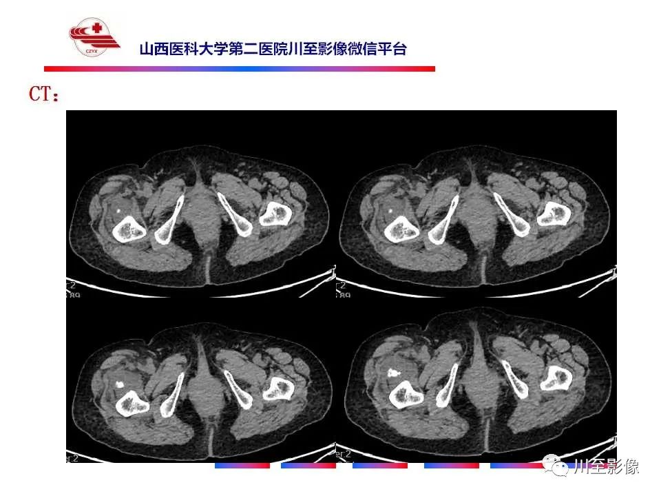 影像PPT - 【病例】大腿高级别表面骨肉瘤-5