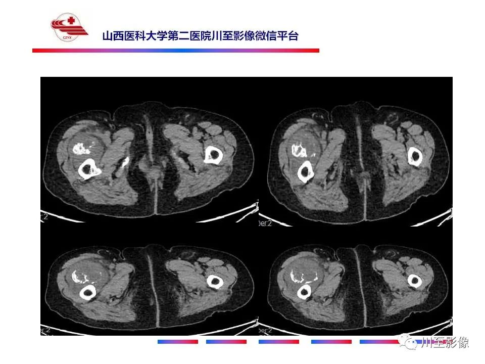 影像PPT - 【病例】大腿高级别表面骨肉瘤-6