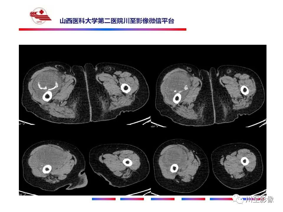 影像PPT - 【病例】大腿高级别表面骨肉瘤-7