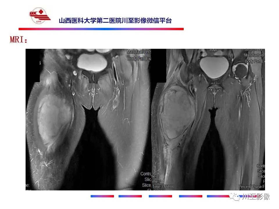 影像PPT - 【病例】大腿高级别表面骨肉瘤-8