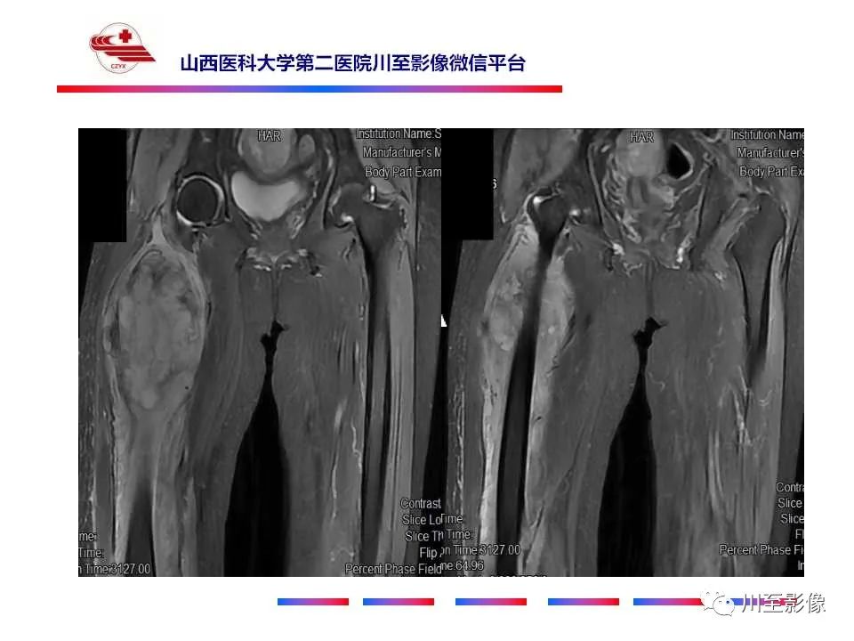 影像PPT - 【病例】大腿高级别表面骨肉瘤-9