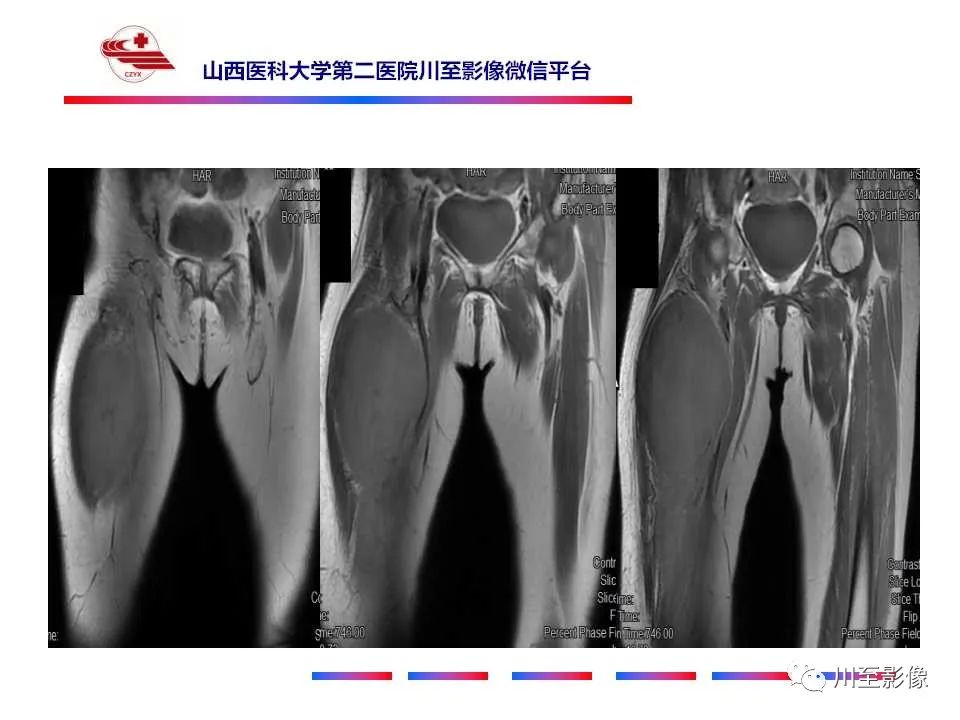 影像PPT - 【病例】大腿高级别表面骨肉瘤-10