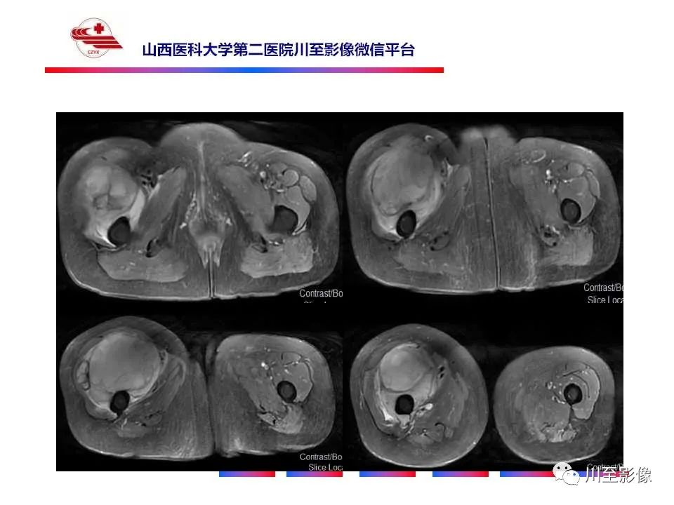 影像PPT - 【病例】大腿高级别表面骨肉瘤-11