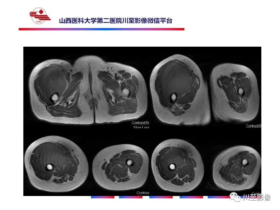 影像PPT - 【病例】大腿高级别表面骨肉瘤-12
