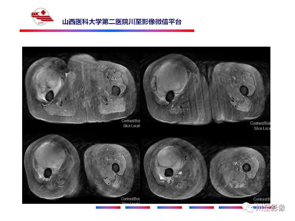 影像PPT - 【病例】大腿高级别表面骨肉瘤-13
