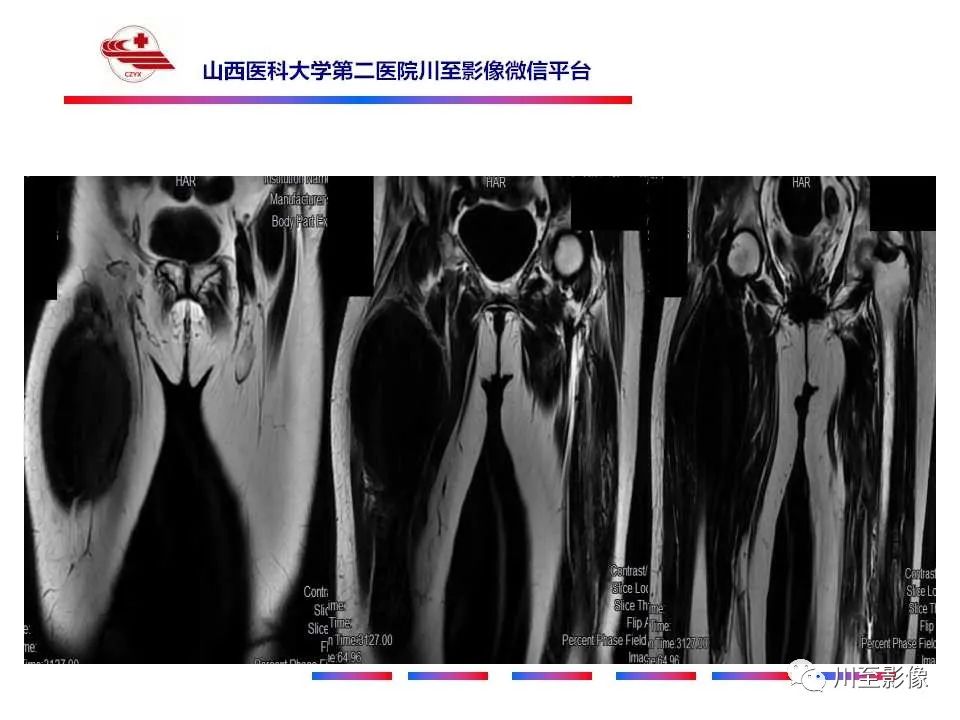 影像PPT - 【病例】大腿高级别表面骨肉瘤-14