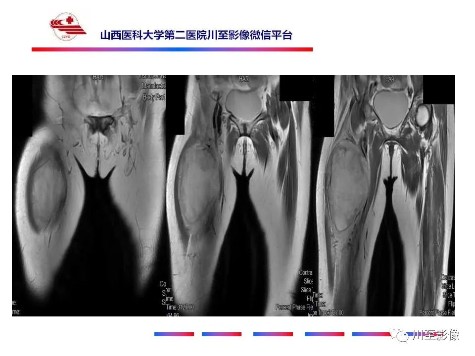 影像PPT - 【病例】大腿高级别表面骨肉瘤-15