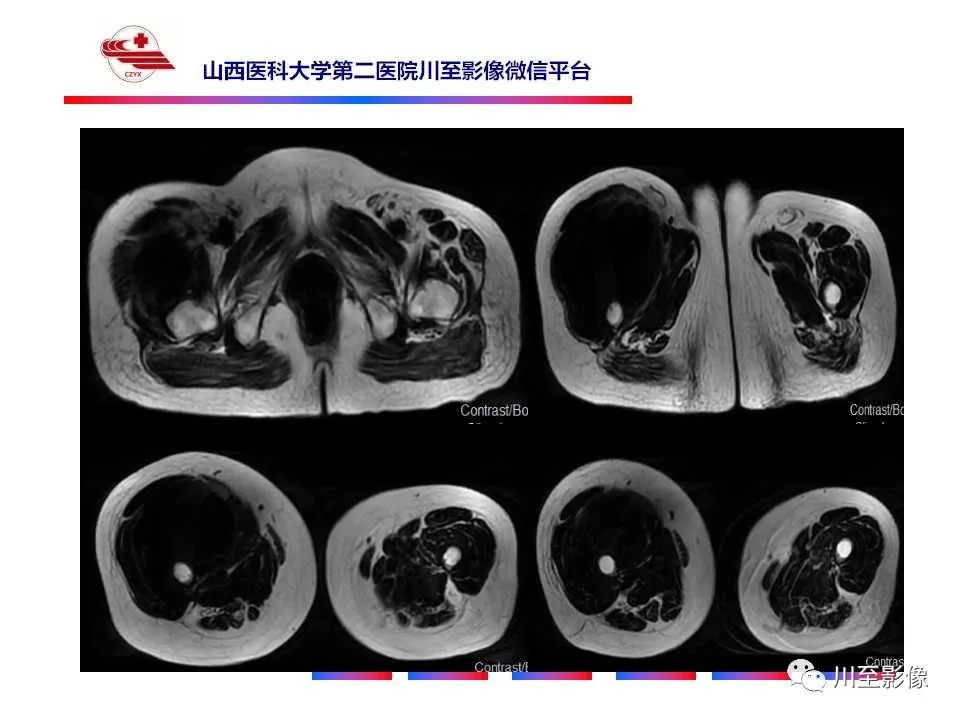 影像PPT - 【病例】大腿高级别表面骨肉瘤-16