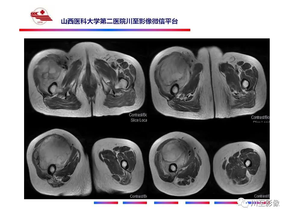 影像PPT - 【病例】大腿高级别表面骨肉瘤-17
