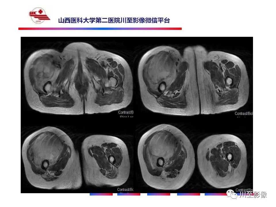 影像PPT - 【病例】大腿高级别表面骨肉瘤-18