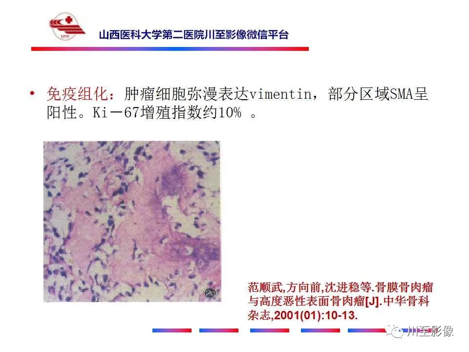 影像PPT - 【病例】大腿高级别表面骨肉瘤-26