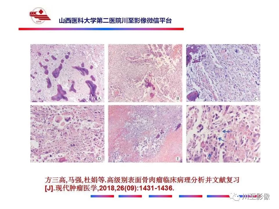 影像PPT - 【病例】大腿高级别表面骨肉瘤-27
