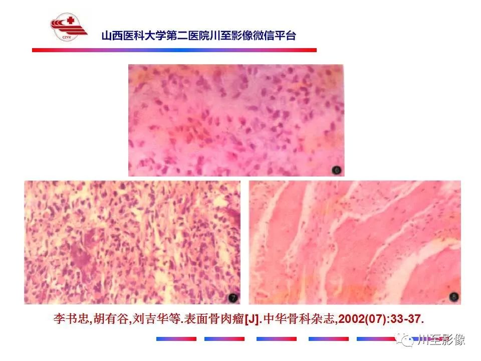 影像PPT - 【病例】大腿高级别表面骨肉瘤-29