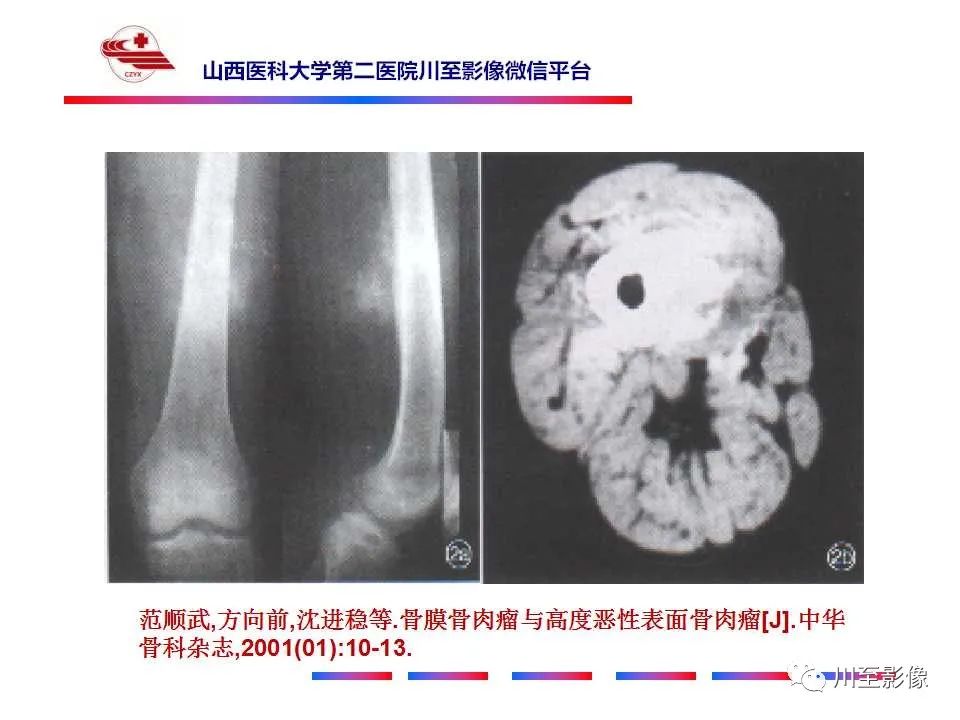 影像PPT - 【病例】大腿高级别表面骨肉瘤-31