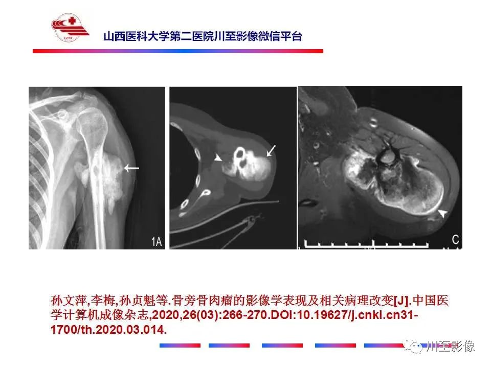 影像PPT - 【病例】大腿高级别表面骨肉瘤-34