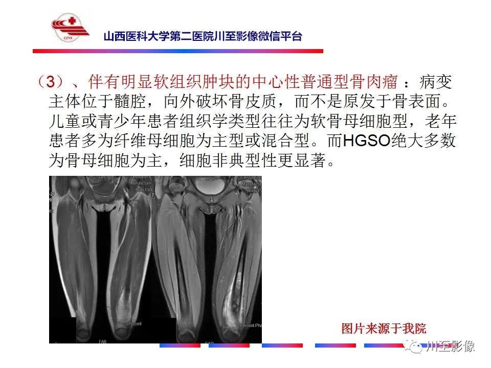 影像PPT - 【病例】大腿高级别表面骨肉瘤-35