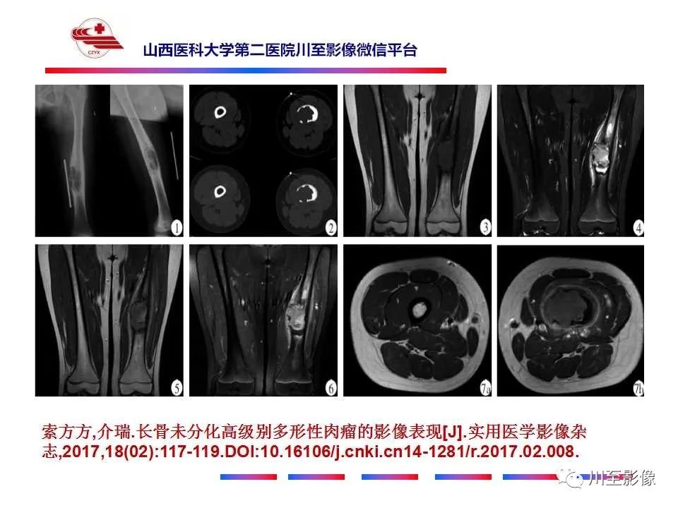 影像PPT - 【病例】大腿高级别表面骨肉瘤-38