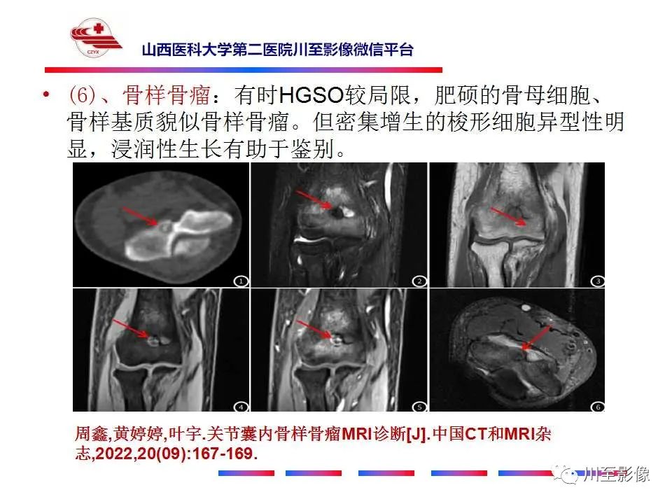 影像PPT - 【病例】大腿高级别表面骨肉瘤-39