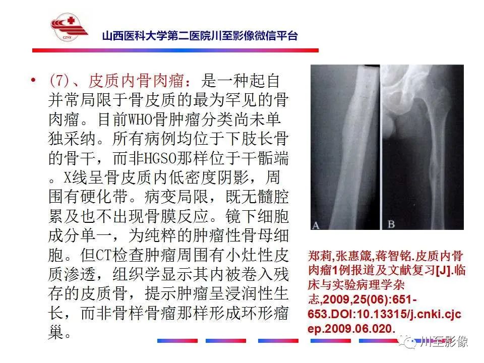 影像PPT - 【病例】大腿高级别表面骨肉瘤-40