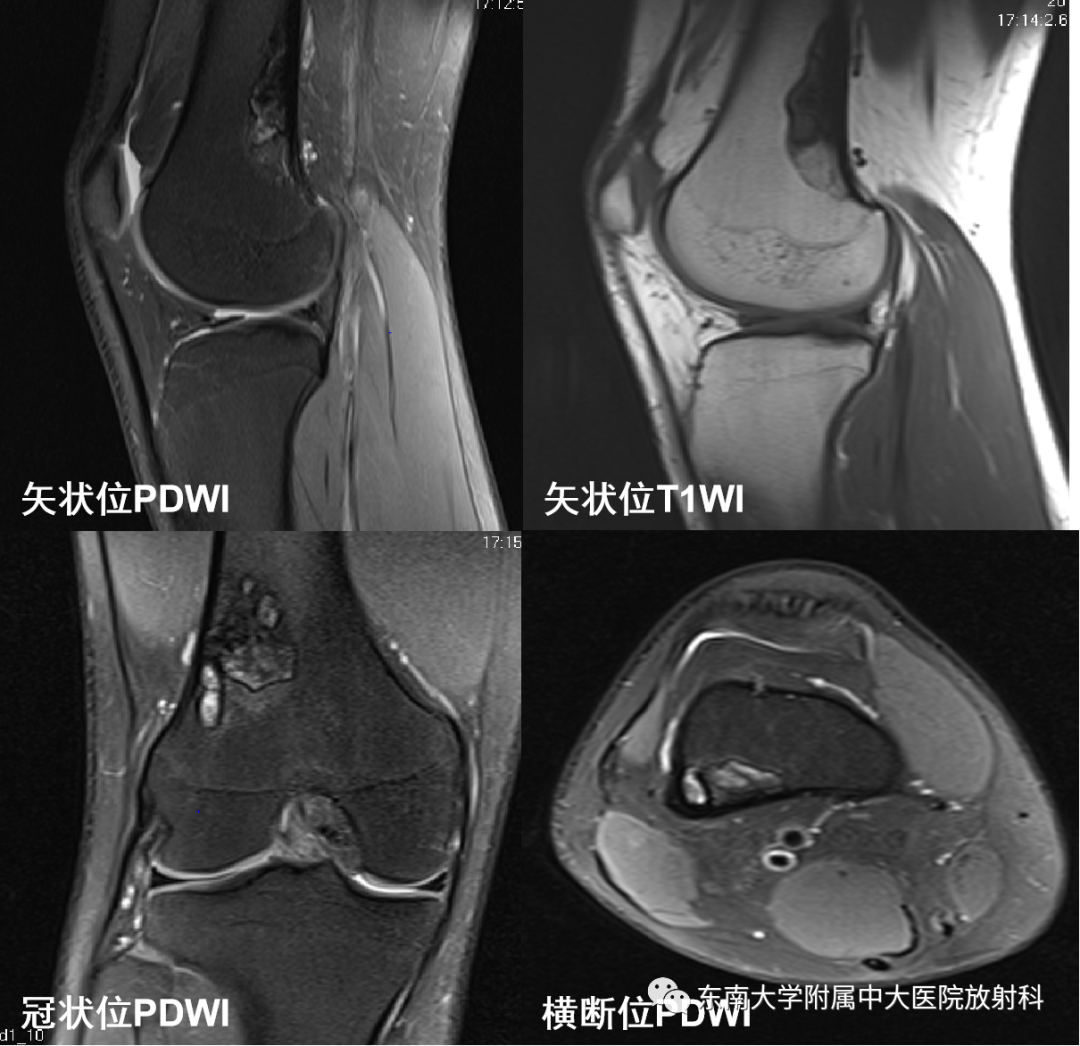 影像PPT - 【PPT】非骨化性纤维瘤-2