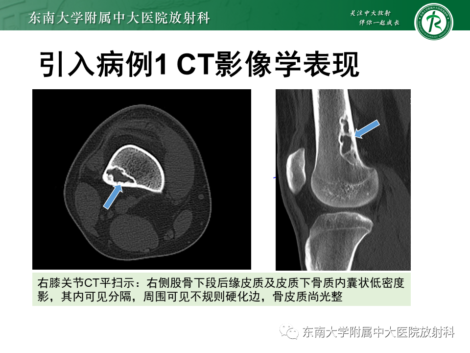 影像PPT - 【PPT】非骨化性纤维瘤-3