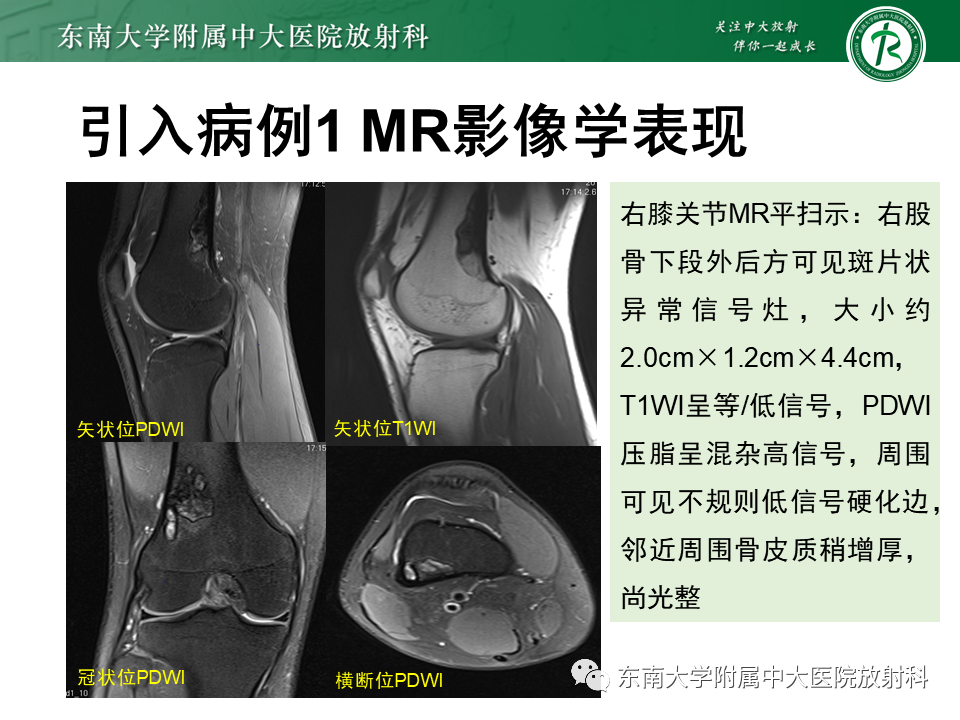 影像PPT - 【PPT】非骨化性纤维瘤-4