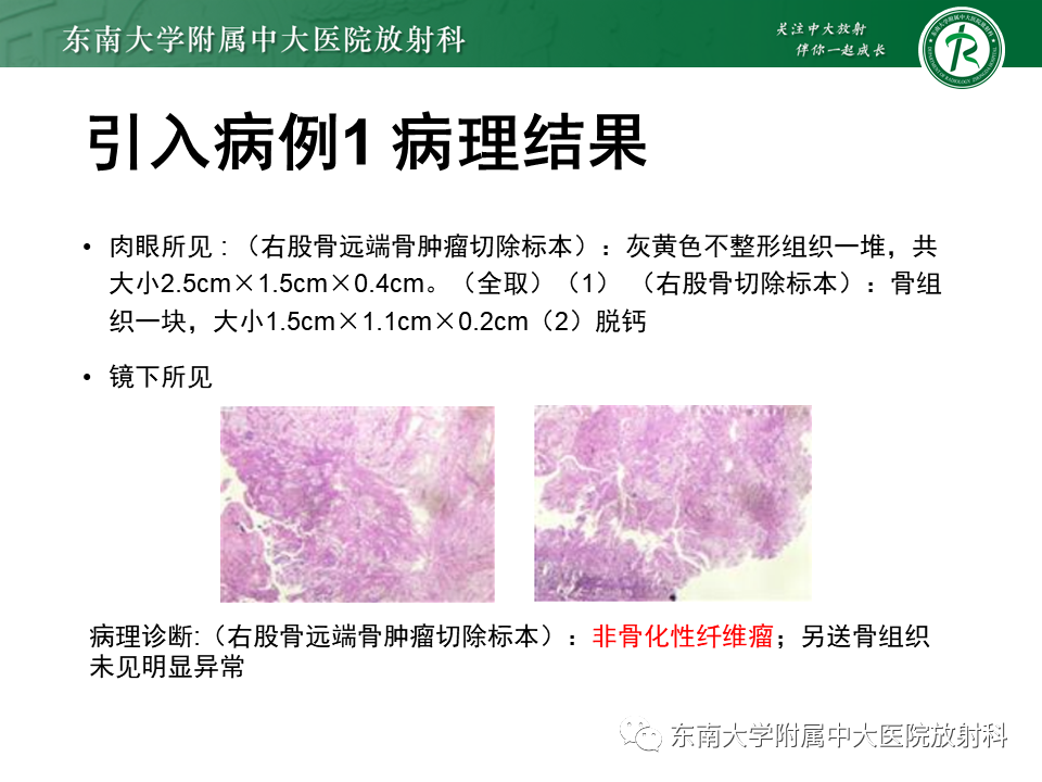 影像PPT - 【PPT】非骨化性纤维瘤-5