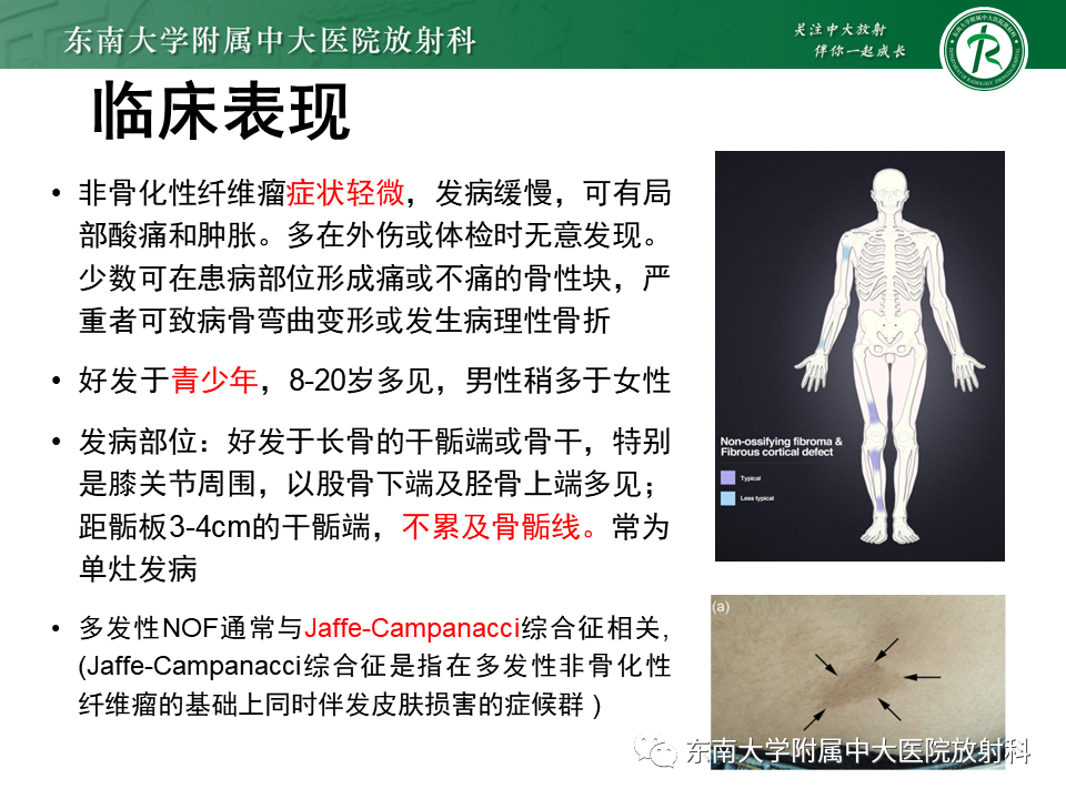 影像PPT - 【PPT】非骨化性纤维瘤-8