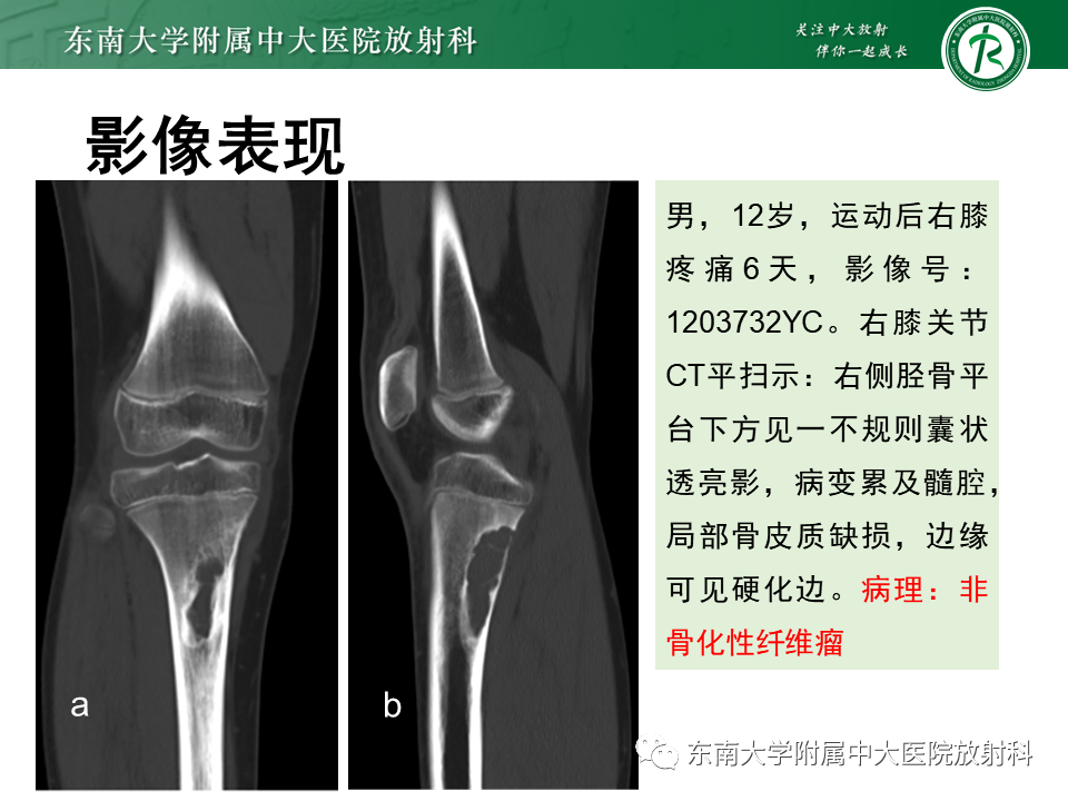 影像PPT - 【PPT】非骨化性纤维瘤-11