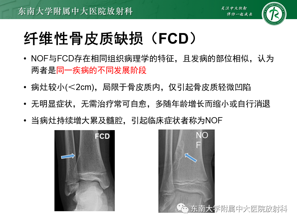 影像PPT - 【PPT】非骨化性纤维瘤-12