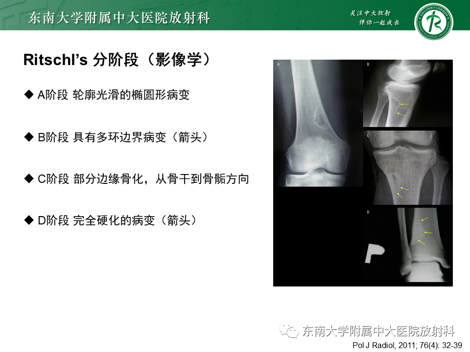 影像PPT - 【PPT】非骨化性纤维瘤-13